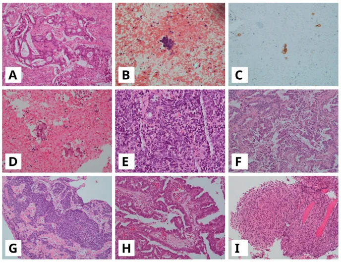 A patient, who was diagnosed with Small Cell Lung Cancer