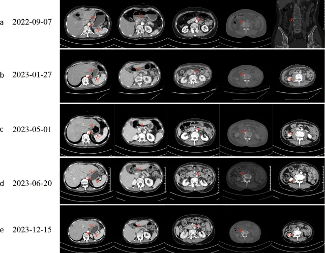 A patient, who was diagnosed with Stage IV Gastric Cancer