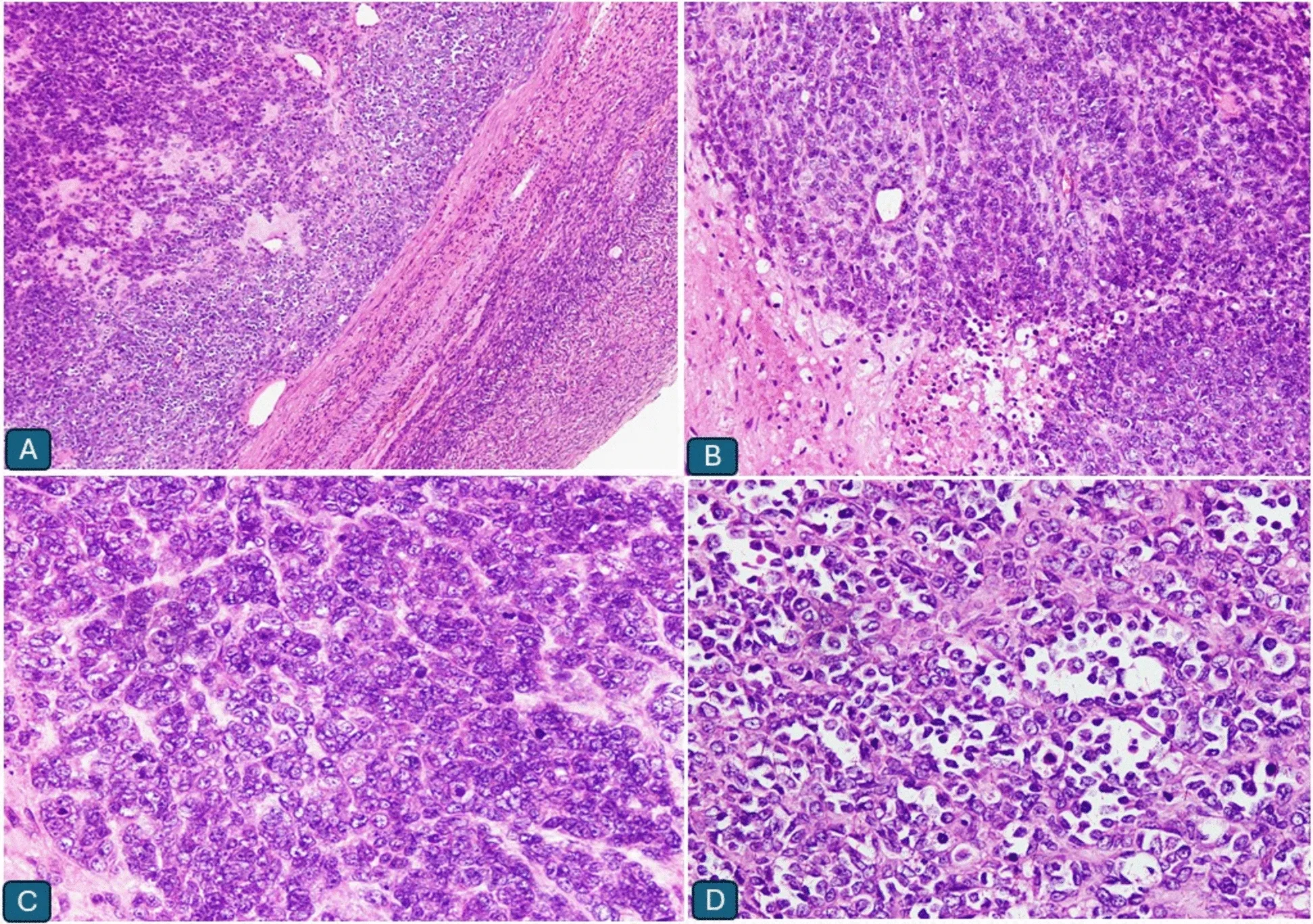A patient, who was diagnosed with Stage III Small Cell Lung Cancer