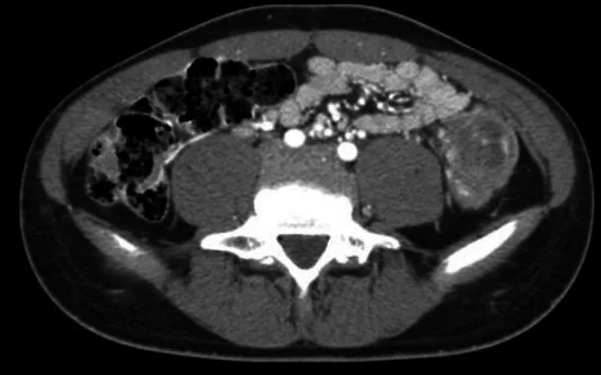 A patient, who was diagnosed with Stage III Colorectal Adenocarcinoma