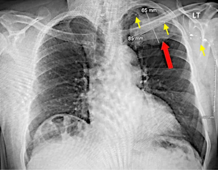 A patient, who was diagnosed with Small Cell Lung Cancer