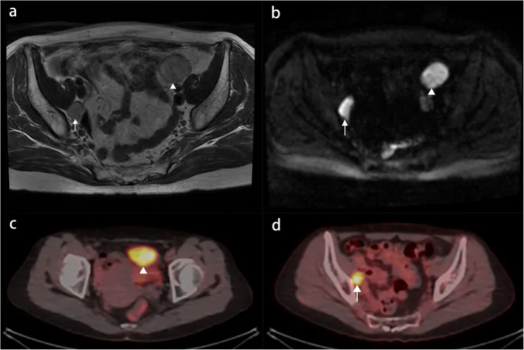 A patient, who was diagnosed with Stage III Ovarian Cancer