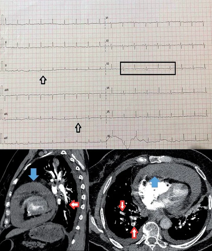 A patient, who was diagnosed with Stage IV Lung Cancer