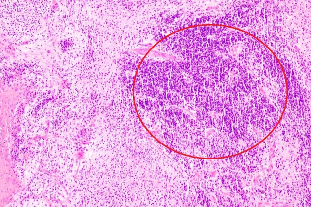 A patient, who was diagnosed with Stage I Ovarian Cancer