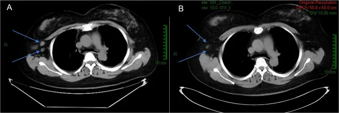 A patient, who was diagnosed with Breast Adenocarcinoma