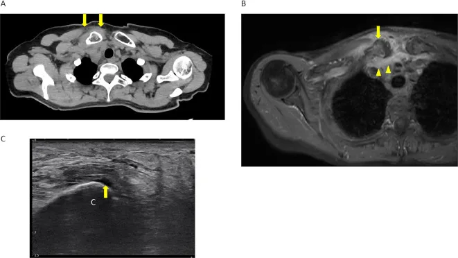 A patient, who was diagnosed with Colorectal Cancer