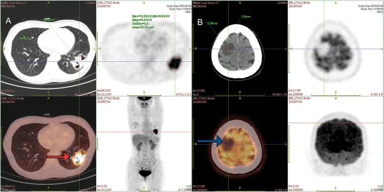 A patient, who was diagnosed with Stage IV Lung Cancer