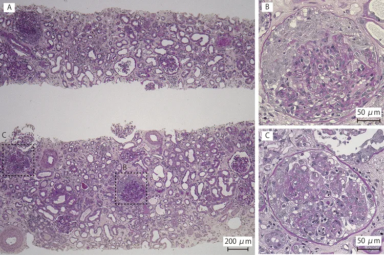 A patient, who was diagnosed with Stage IV Lung Squamous Cell Carcinoma