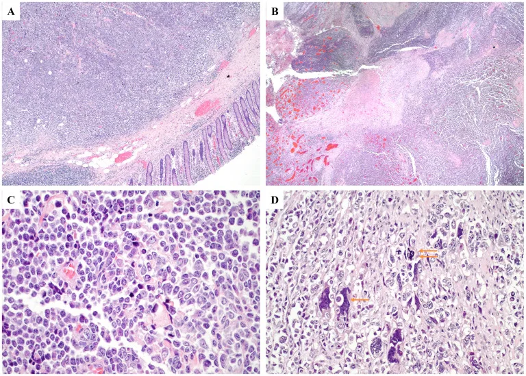 A patient, who was diagnosed with Colorectal Cancer