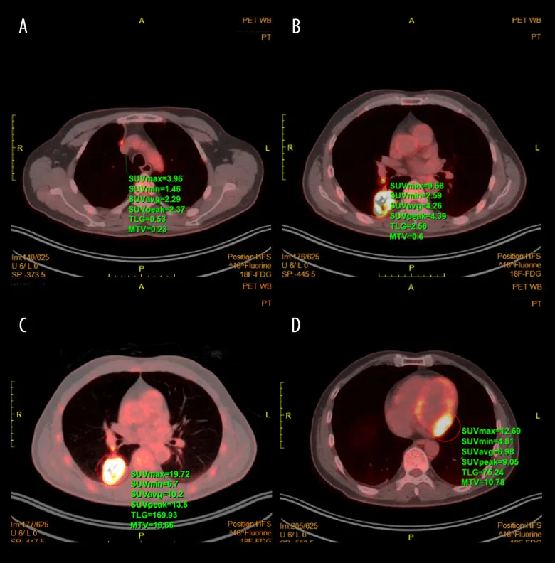 A patient, who was diagnosed with Stage IV Non-Small Cell Lung Cancer
