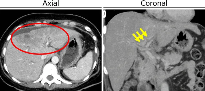 A patient, who was diagnosed with Stage IV Breast Cancer