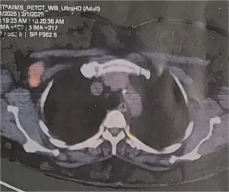 A patient, who was diagnosed with Stage IV Ovarian Cancer
