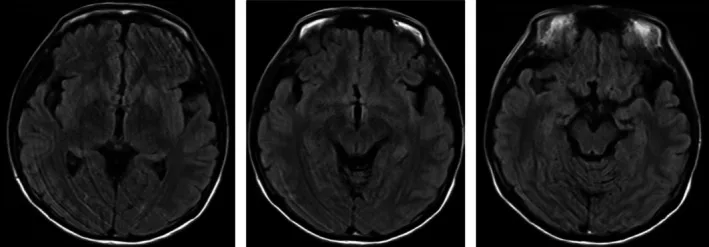 A patient, who was diagnosed with Ovarian Cancer