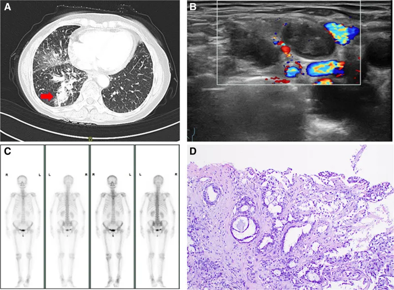A patient, who was diagnosed with Stage IV Lung Adenocarcinoma