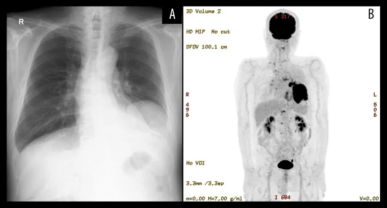 A patient, who was diagnosed with Stage IV Lung Squamous Cell Carcinoma