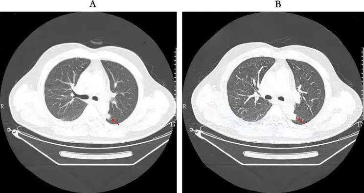 A patient, who was diagnosed with Stage IV Lung Adenocarcinoma