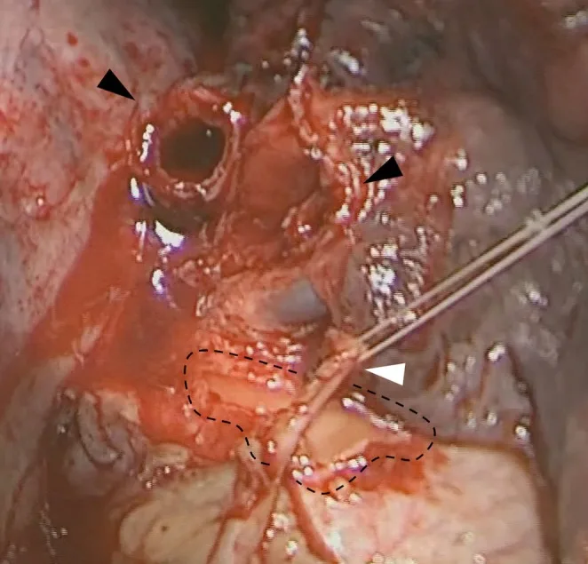 A patient, who was diagnosed with Stage II Lung Squamous Cell Carcinoma
