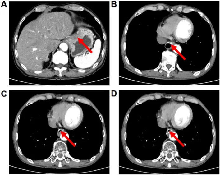 A patient, who was diagnosed with Stage III Gastric Adenocarcinoma