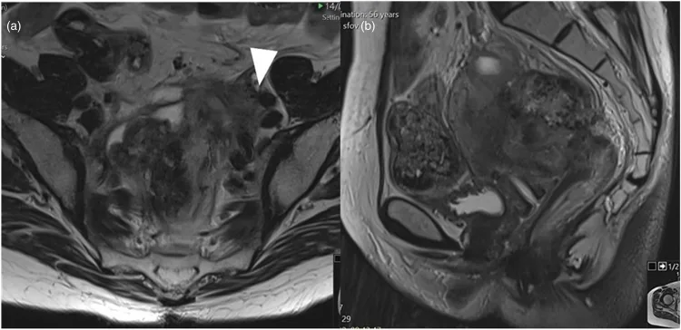 A patient, who was diagnosed with Stage IV Colorectal Adenocarcinoma