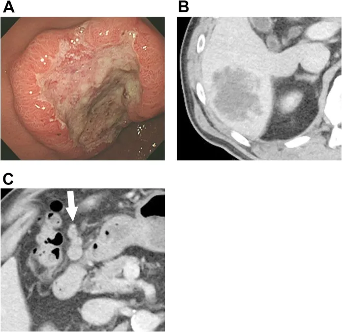 A patient, who was diagnosed with Stage IV Gastric Adenocarcinoma