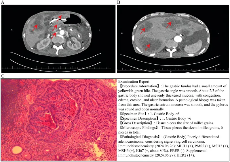 A patient, who was diagnosed with Stage IV Gastric Adenocarcinoma