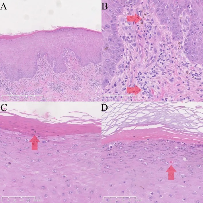 A patient, who was diagnosed with Stage II Lung Adenocarcinoma