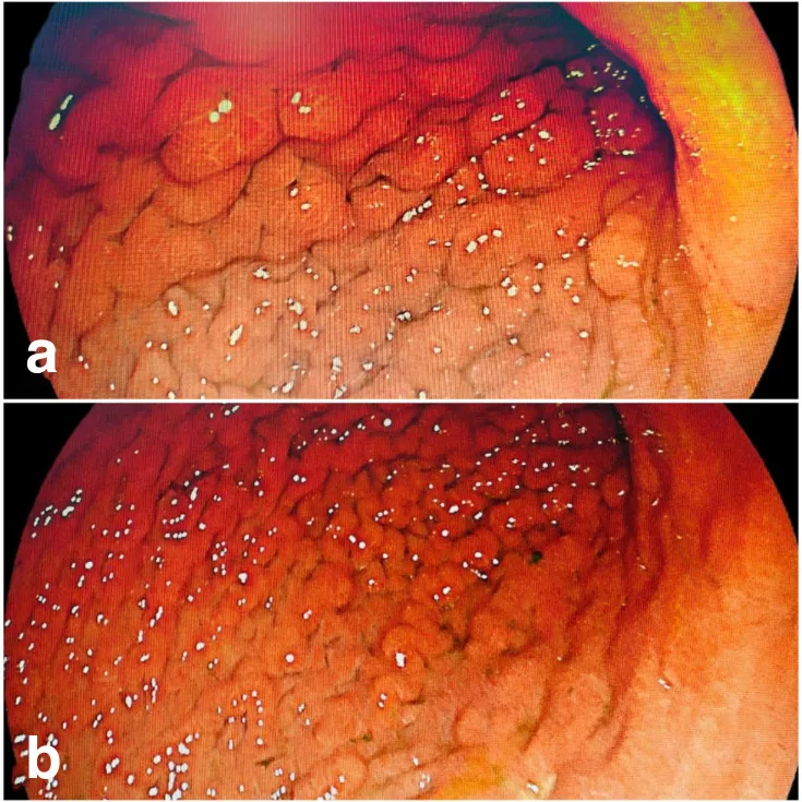 A patient, who was diagnosed with Gastric Cancer