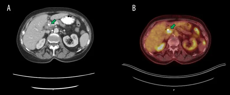 A patient, who was diagnosed with Lung Adenocarcinoma