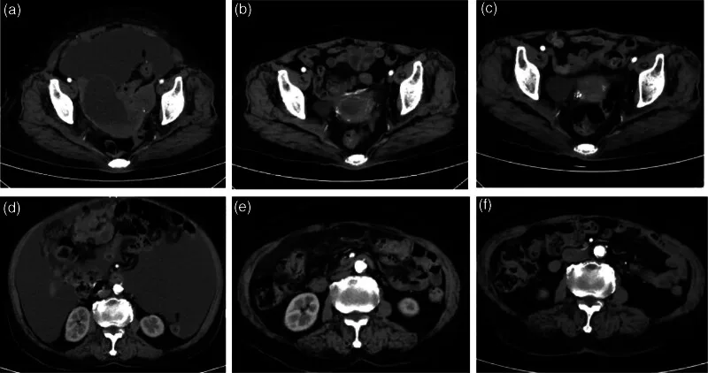 A patient, who was diagnosed with Stage IV Ovarian Cancer