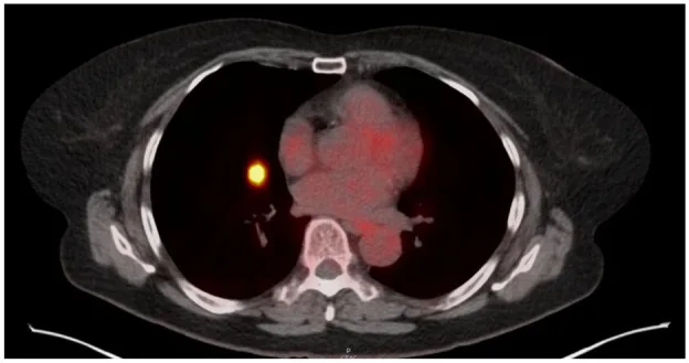 A patient, who was diagnosed with Inflammatory Breast Cancer