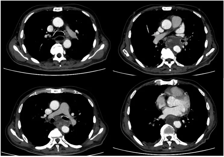A patient, who was diagnosed with Stage IV Lung Cancer