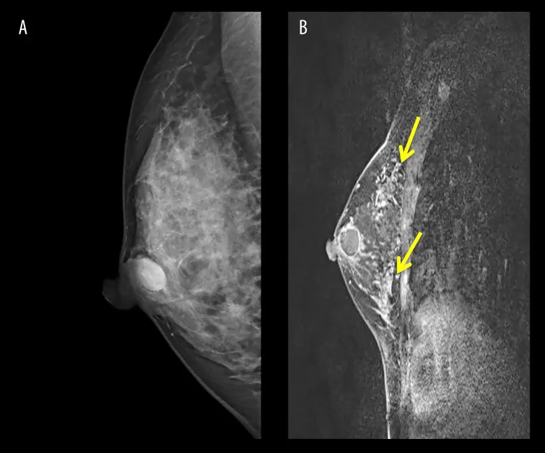 A patient, who was diagnosed with Breast Cancer