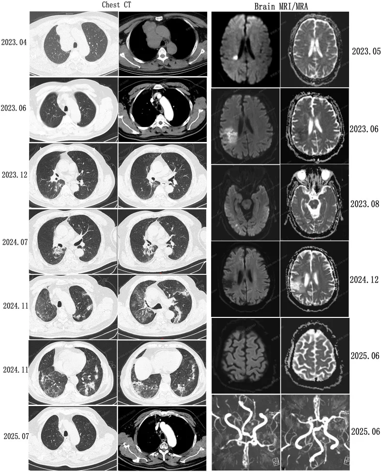 A patient, who was diagnosed with Small Cell Lung Cancer