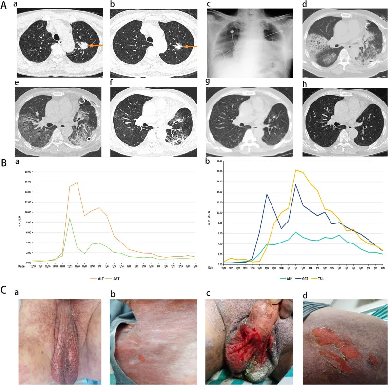 A patient, who was diagnosed with Stage III Lung Adenocarcinoma