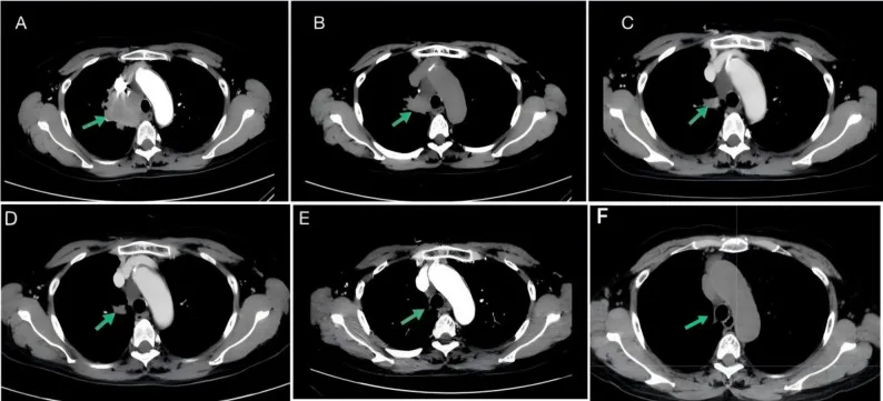 A patient, who was diagnosed with Stage III Lung Squamous Cell Carcinoma