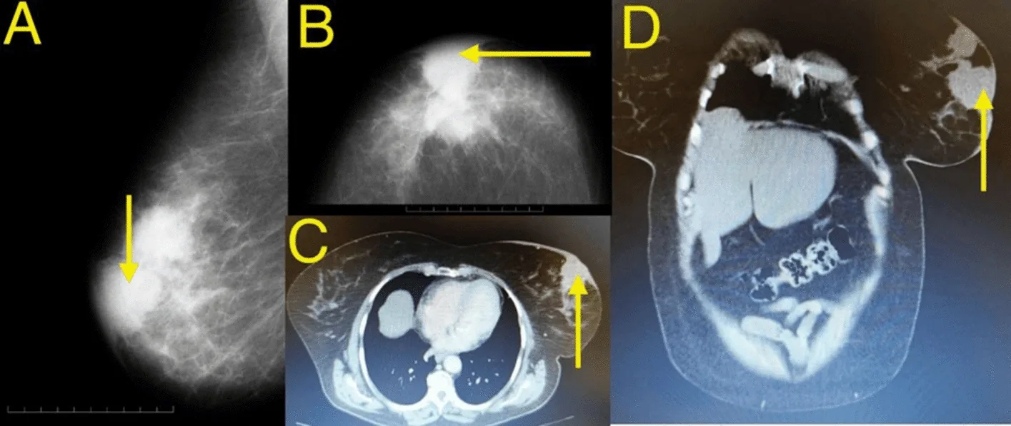 A patient, who was diagnosed with Stage IV Invasive Ductal Carcinoma