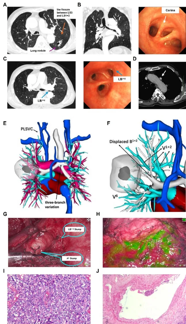 A patient, who was diagnosed with Lung Squamous Cell Carcinoma