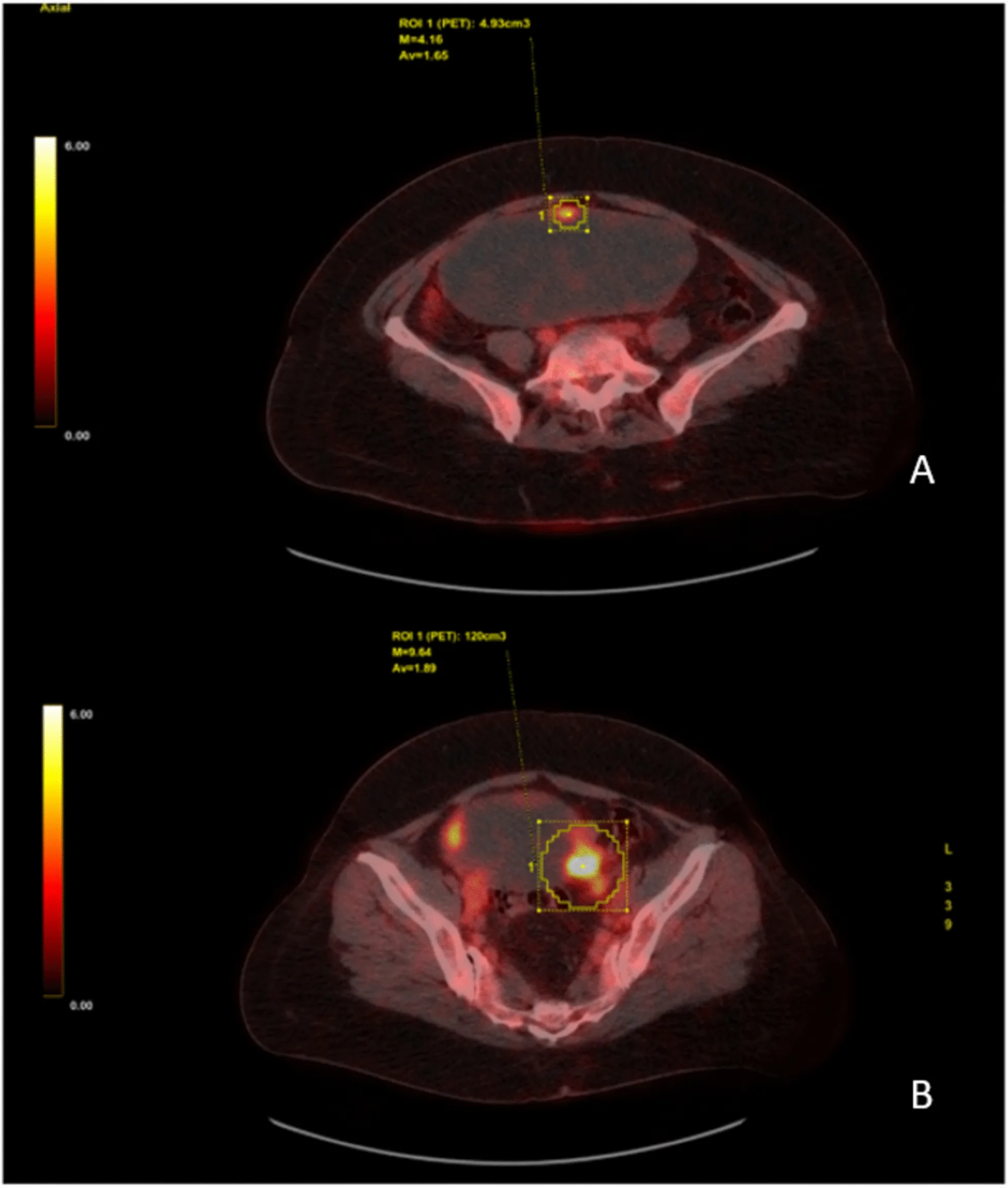 A patient, who was diagnosed with Ovarian Cancer