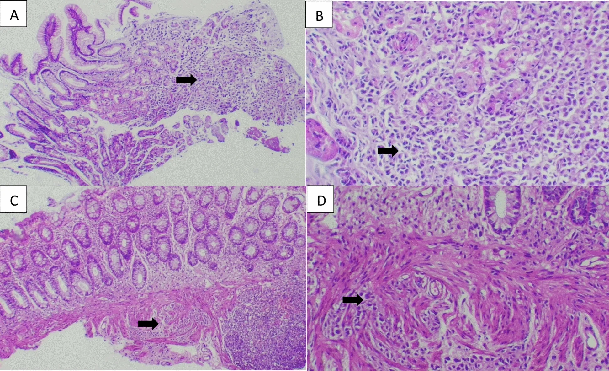 A patient, who was diagnosed with Stage IV Invasive Lobular Carcinoma
