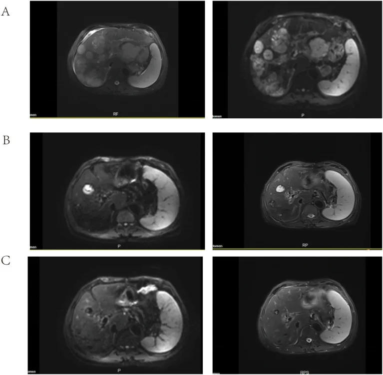 A patient, who was diagnosed with Stage IV Gastric Cancer