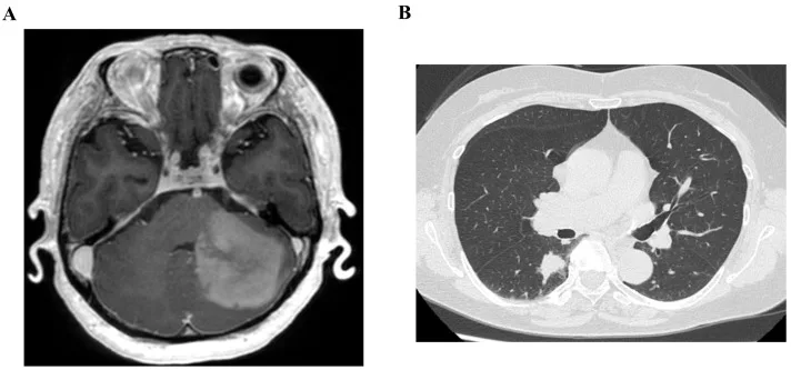A patient, who was diagnosed with Stage I Lung Adenocarcinoma