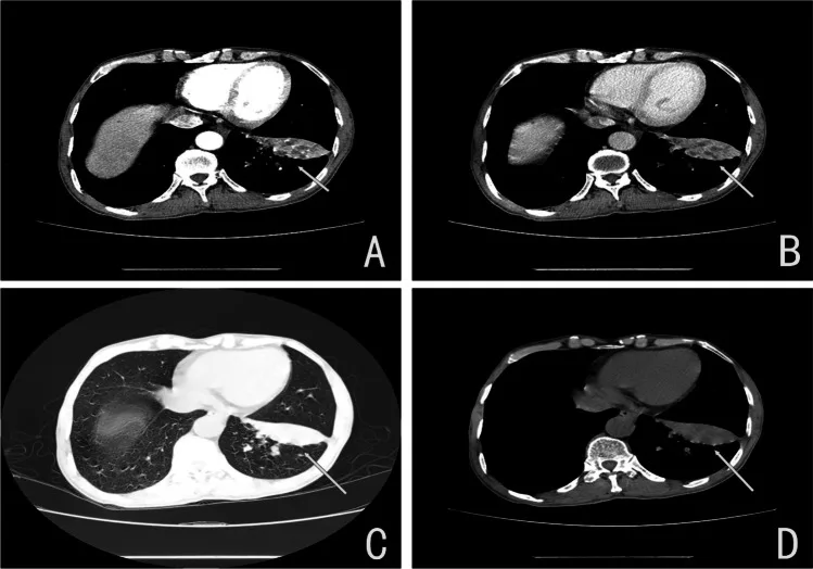 A patient, who was diagnosed with Stage I Lung Cancer