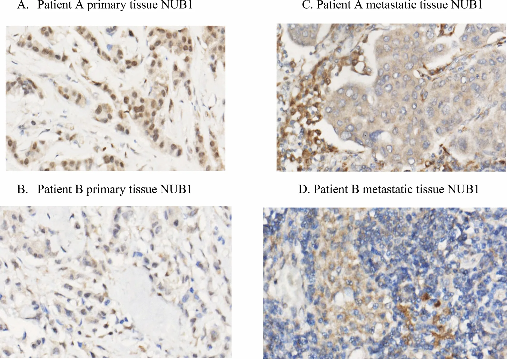 A patient, who was diagnosed with Invasive Ductal Carcinoma