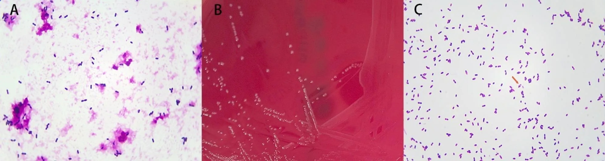 A patient, who was diagnosed with Colorectal Adenocarcinoma