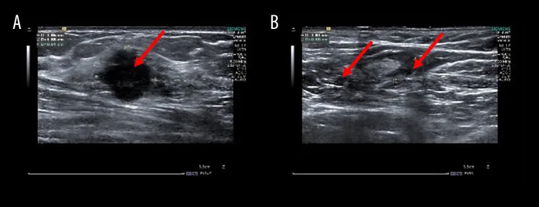 A patient, who was diagnosed with Invasive Ductal Carcinoma