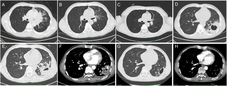 A patient, who was diagnosed with Stage IV Non-Small Cell Lung Cancer