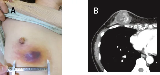A patient, who was diagnosed with Stage III Breast Cancer