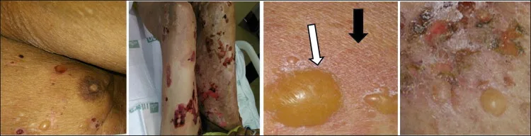 A patient, who was diagnosed with Colorectal Adenocarcinoma