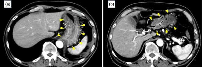 A patient, who was diagnosed with Stage IV Lung Squamous Cell Carcinoma