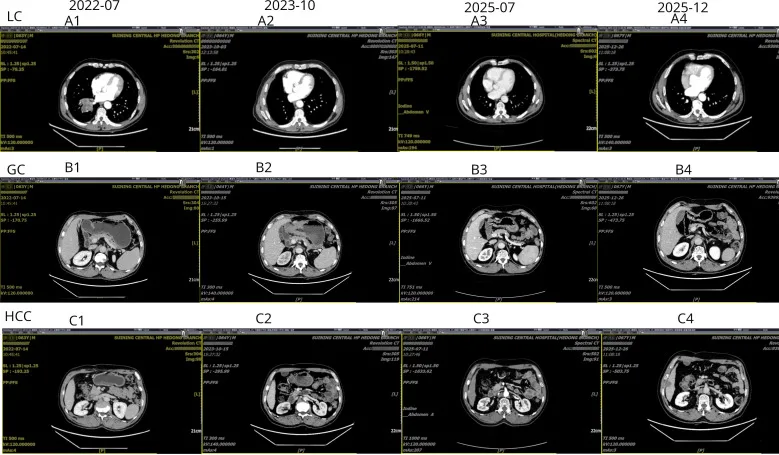 A patient, who was diagnosed with Multiple primary cancers Adenocarcinoma
